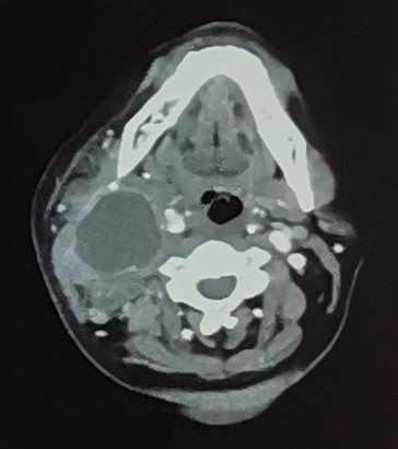 CT of the neck shows a collection within the right carotid space with anterior displacement of the right submandibular gland, right common carotid artery and internal jugular vein