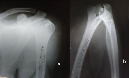 Ipsilateral shoulder and elbow dislocation